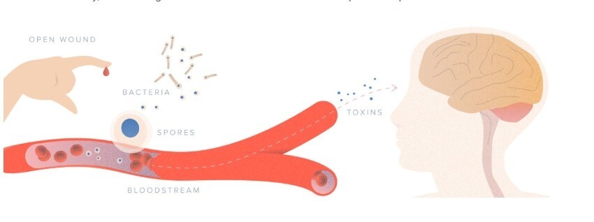 Tetanus Protection What Is Tetanus? Symptoms, Risks & Why Travel… | Ready Health